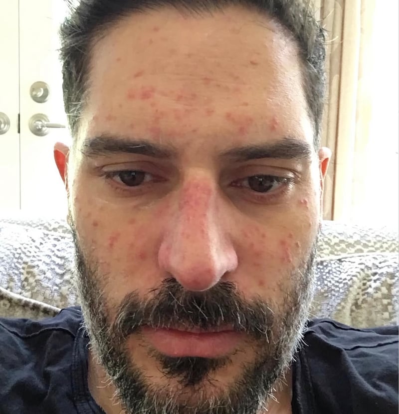In one of the photos, Joe Manganiello showed a facial rash.