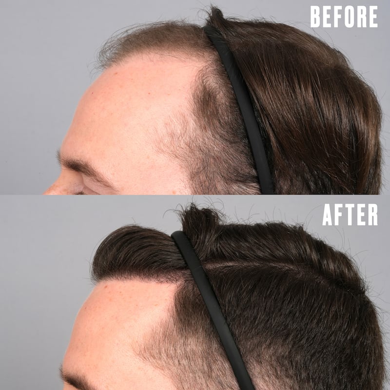Jordan went through hair transplant surgery with Dr. Gary Linkov at Linkov Hair Surgery in New York City.