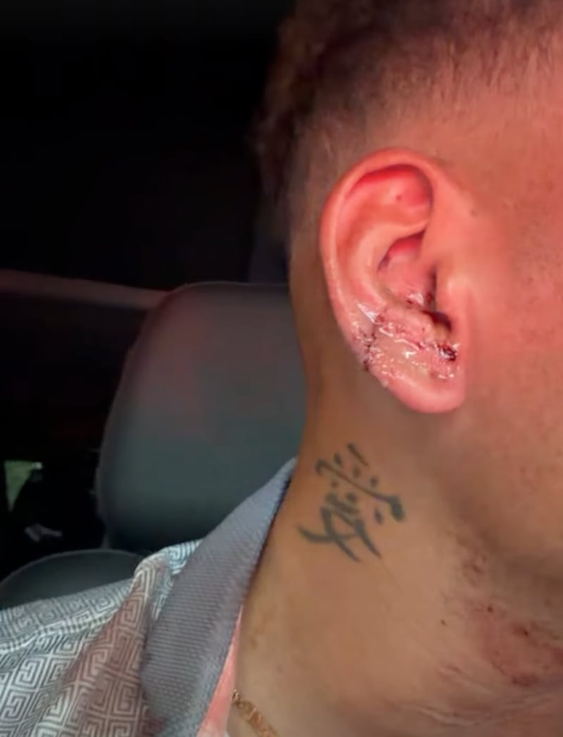 Kane Brown shares a video of his stitched ear on his Instagram story after being struck with a golf ball.