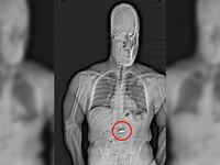 Orlando police released an x-ray image that appeared to show a foreign object in the suspect's abdomen.