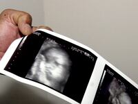articles/2012/05/30/ronald-reagan-the-silent-scream-and-the-slow-rise-of-fetal-pain/fetus-pain-fight-yarrow_jbgdle