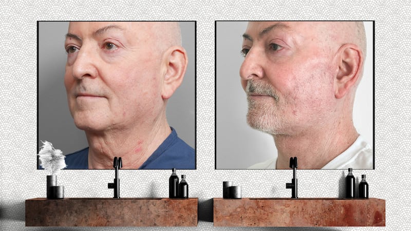 David's jawline transformation. 3/4 view