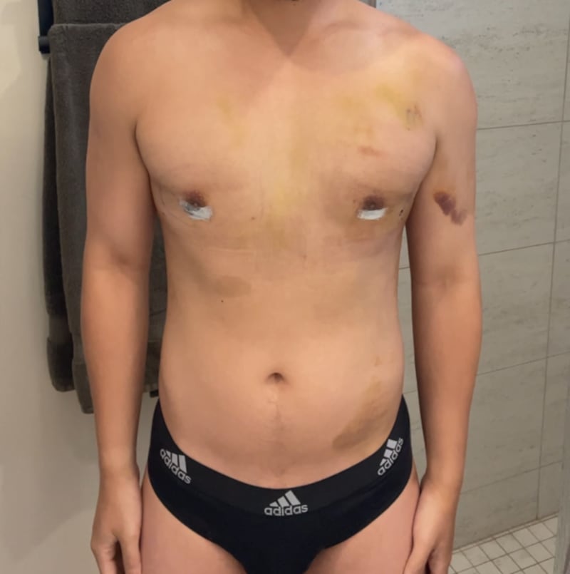 Jon Michael during recovery.