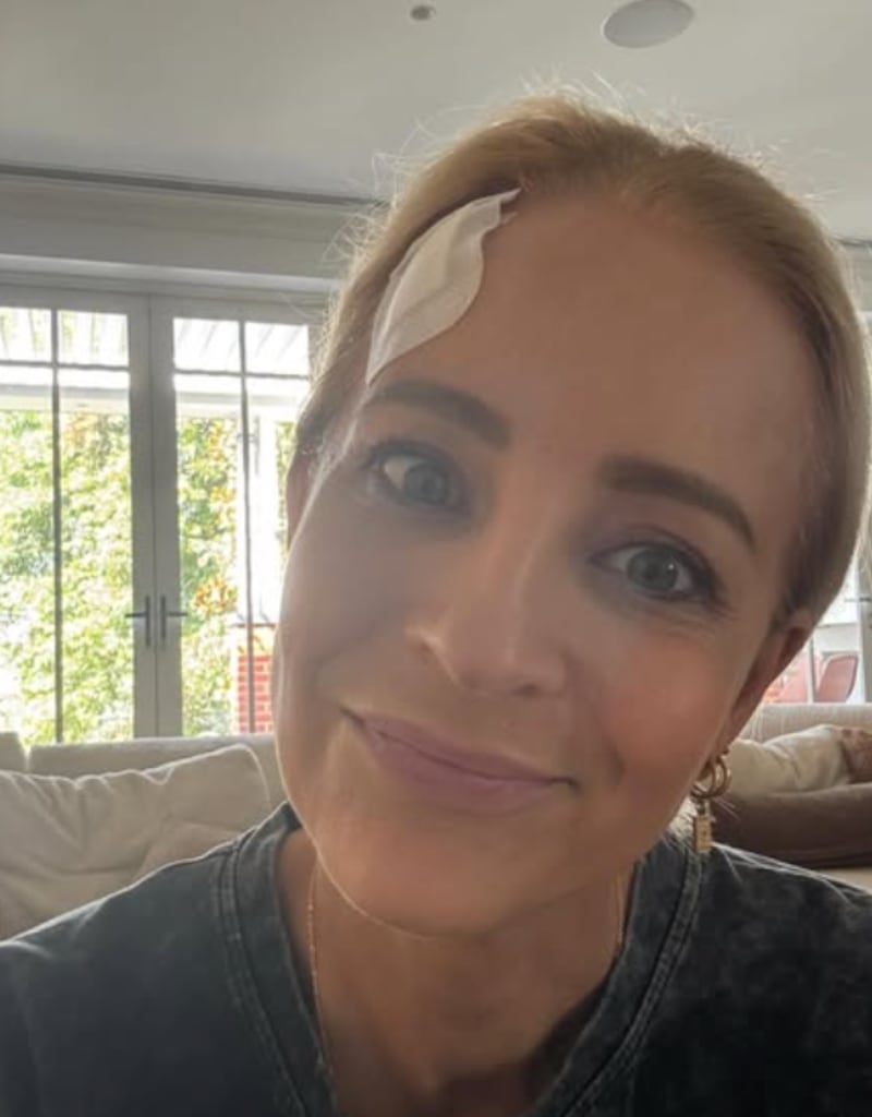 Carrie Bickmore showing her head injury as it heals