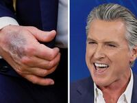 Discoloration on Donald Trump's hand and Gavin Newsom