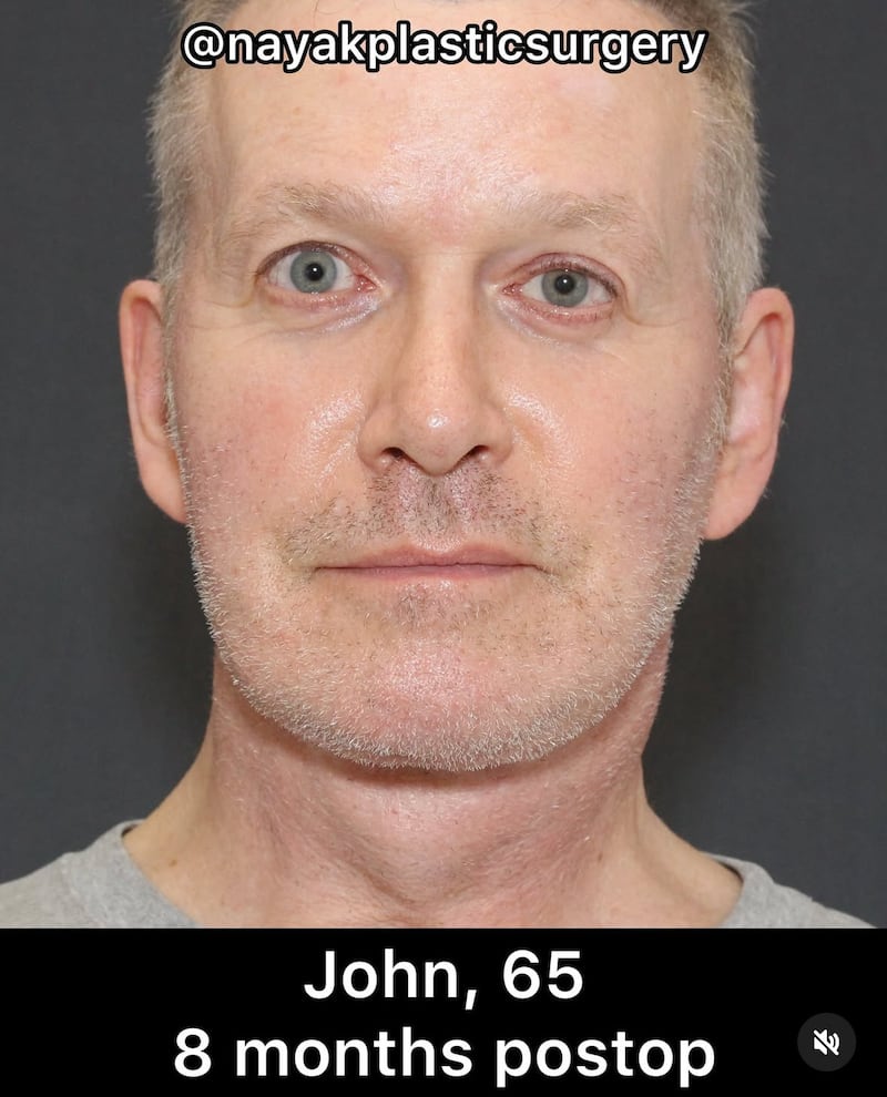 Photo of John Spaedy eight months post-operation.