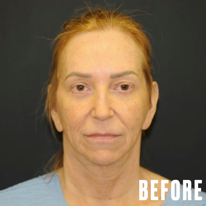 This Woman Underwent Surgery to Fix Common GLP-1 Side Effects - The Looker