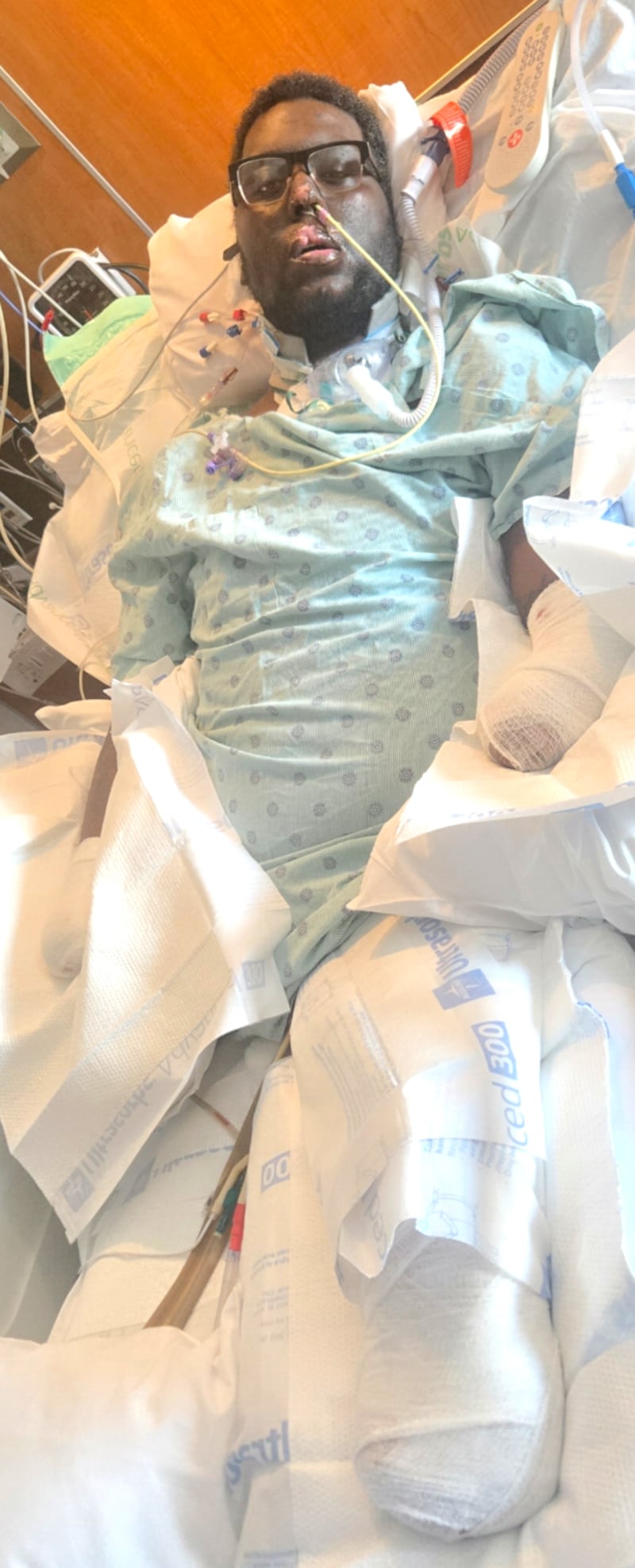 Vanterpool had to undergo amputation of four limbs.