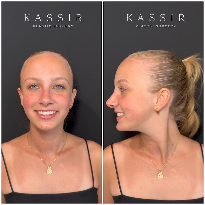 nose job