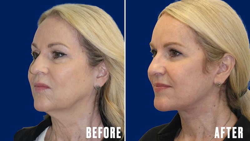 The Looker - This Woman's Facelift Had People Mistaking Her For Her Daughter