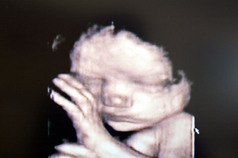 articles/2012/06/08/new-finding-that-testing-could-identify-defects-in-fetuses-is-a-genetics-baby-step/fetus-ultrasound-sepkowitz_qukgac