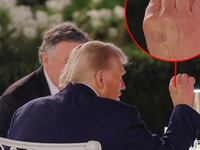 Discoloration is seen on Trump's right hand.
