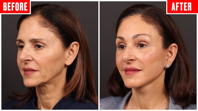 Before and after photos showing a couple who got face lifts