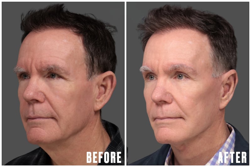 Before and After - The Looker - Man Undergoes Facelift After Noticing His Reflection Looked 'Angry'