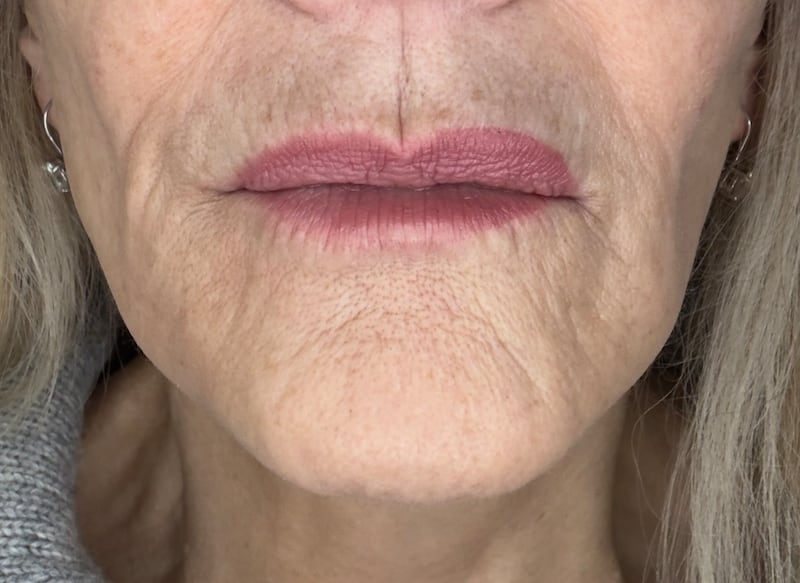 Pamela Allyn wanted to treat the lines on her forehead and around her mouth. This picture was taken before the croton oil peel treatment.