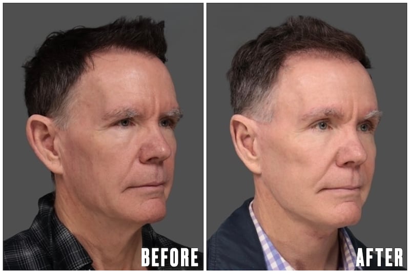 Before and After - The Looker - Man Undergoes Facelift After Noticing His Reflection Looked 'Angry'