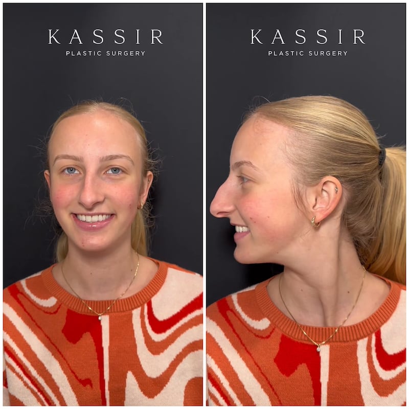 nose job