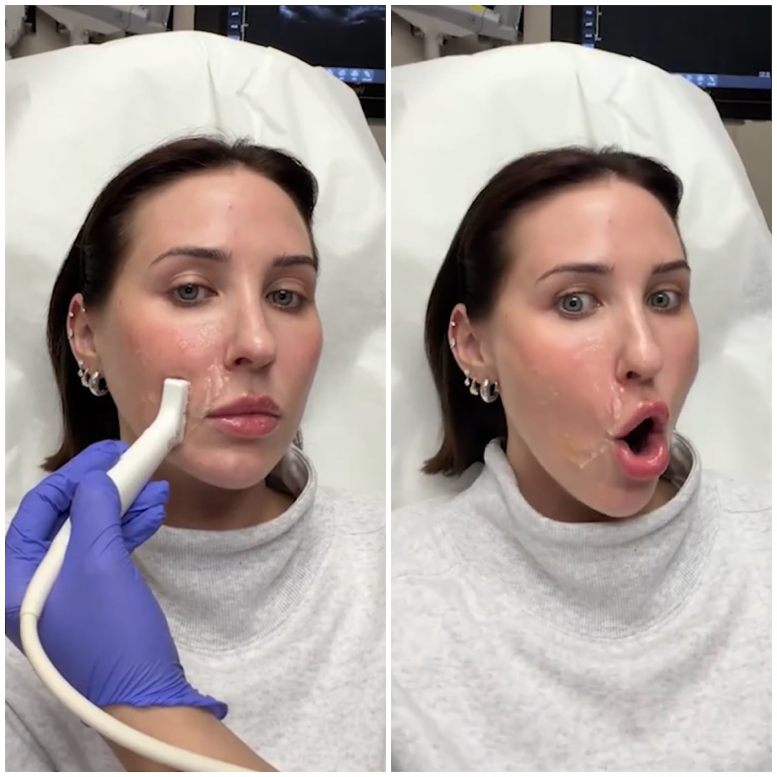 The doctor discovered migrated filler during Jaclyn Hill's ultrasound.