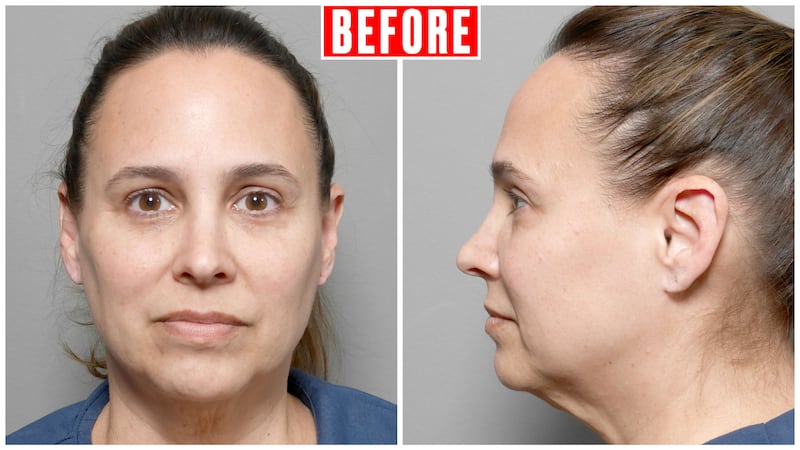 Woman Gets a Facelift After Losing 80 Pounds on GLP-1s for the Looker.