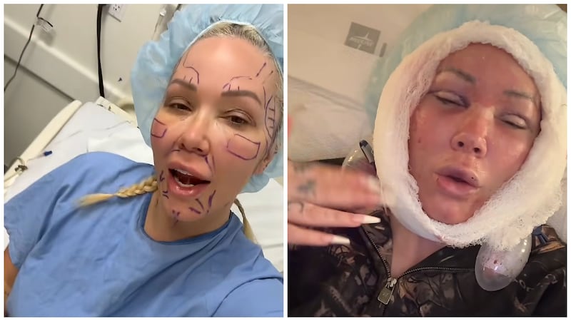 Bunnie Xo before and after undergoing facelift surgery