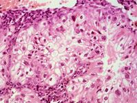 cheats/2017/01/23/cervical-cancer-deadlier-in-u-s-than-thought-death-toll-cancer/170123-cervical-cancer-study-cheat_vk0qqz