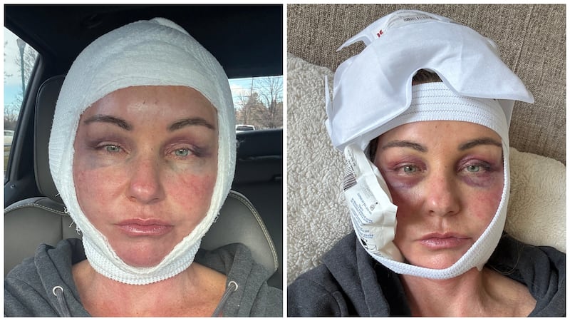 Chari Pack experienced a lot of bruising after her surgery, but described the pain as a "bad migraine" at worst.