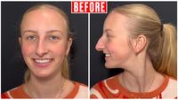 "Before" photos of Dr. Kassir's rhinoplasty patient, Jacqueline.