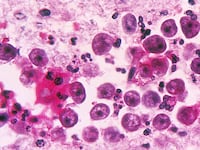 articles/2011/12/23/brain-eating-amoeba-cases-puzzle-and-worry-scientists/neti-pots-amoeba-begley_ewodhz