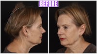 Beverly facelift results for The Looker.
