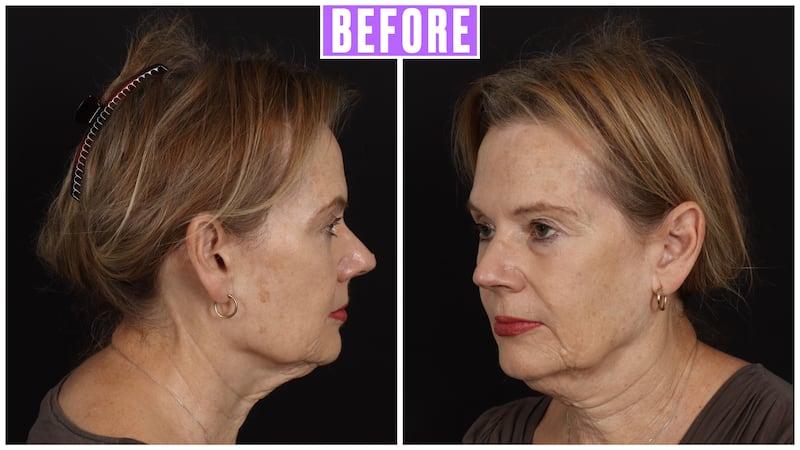 Beverly facelift results for The Looker.