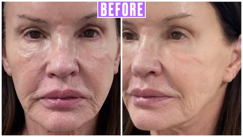 Janice Dickinson Debuts Incredible Facelift Results at 71