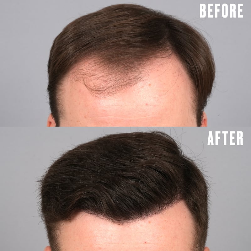 Jordan went through hair transplant surgery with Dr. Gary Linkov at Linkov Hair Surgery in New York City.