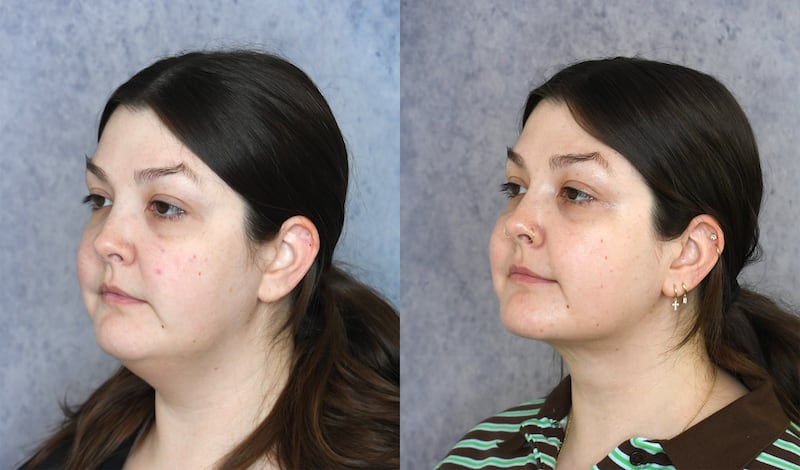 A photo illustration of chin lipo suction before and after for the Looker.
