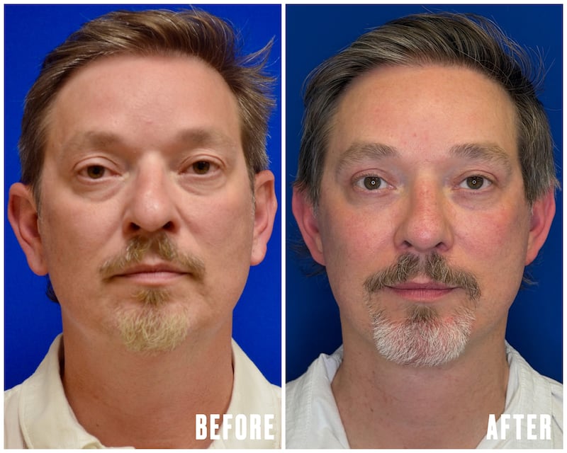 For His 50th Birthday, He Got Six Plastic Surgery Procedures for The Looker
