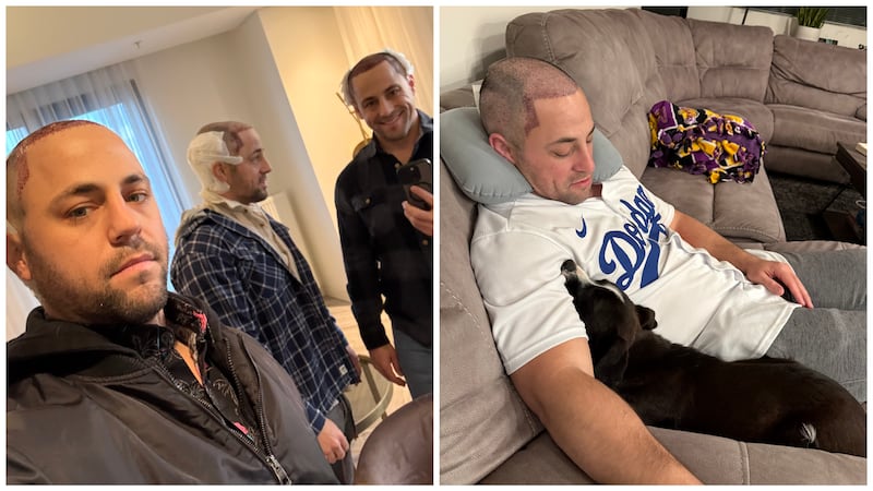Alex Virzi described the first three months following the surgery as "the ugly duckling phase," and said sleeping was the hardest part of the recovery for the first 10. "You have to sleep at an incline with a weird airline pillow," Sean added.