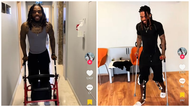 Influencer shares his leg-lengthening surgery recovery.