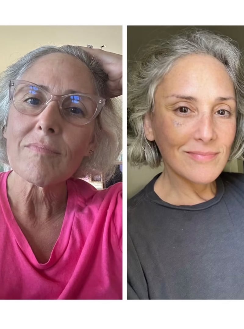 Ricki Lake reveals her before and after facelift photos
