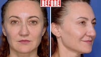 Looker - Her Upper Eyelid Surgery Took Just Two Hours But Took Years Off Her Face