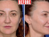 Looker - Her Upper Eyelid Surgery Took Just Two Hours But Took Years Off Her Face