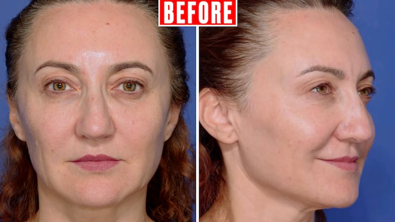 Looker - Her Upper Eyelid Surgery Took Just Two Hours But Took Years Off Her Face