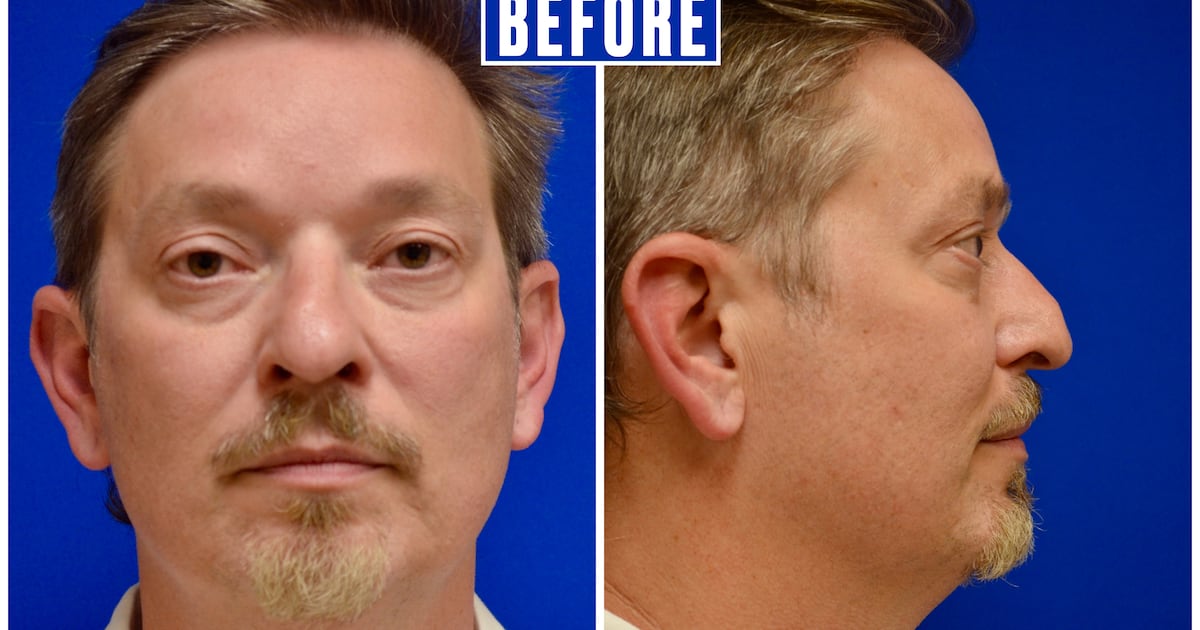 Man Gets Midlife Makeover With Chin Implant, Facelift, and Nose Job
