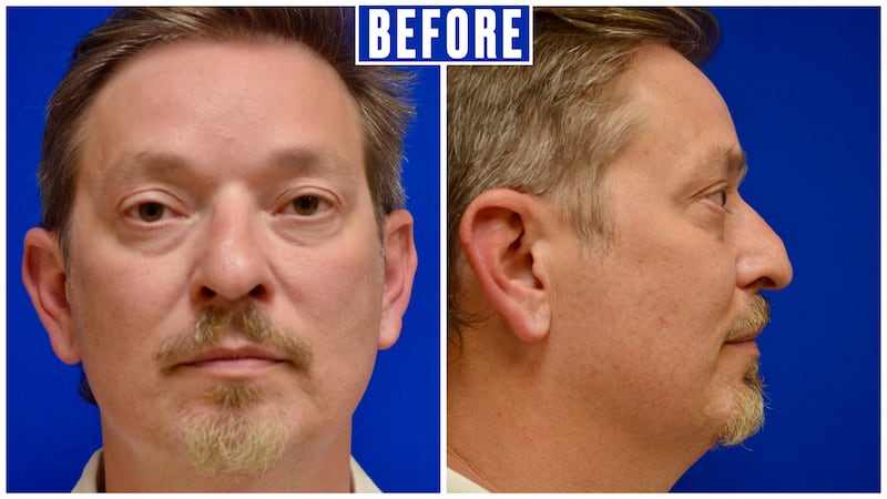 For His 50th Birthday, He Got Six Plastic Surgery Procedures for The Looker