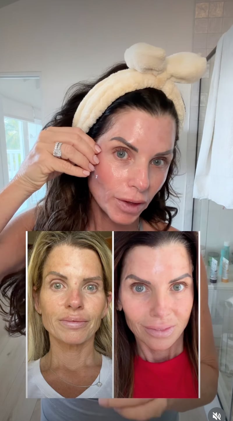 Elaine Manthei Facelift