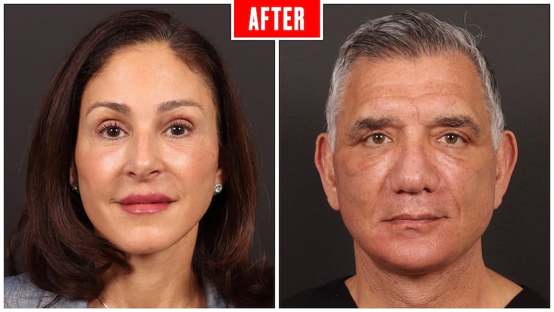 Before and after photos showing a couple who got face lifts
