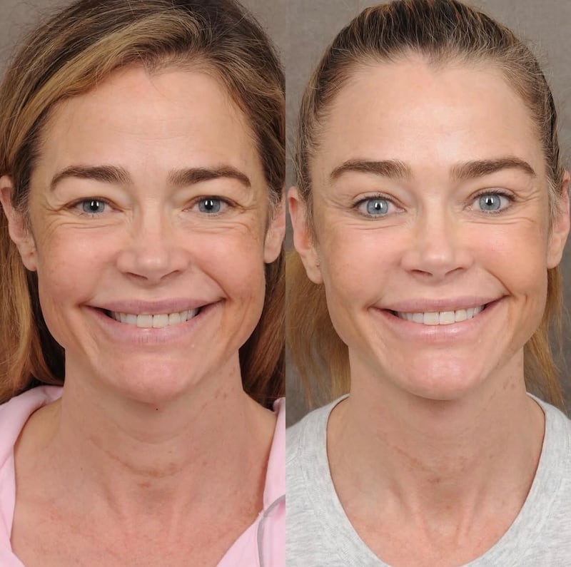 Denise Richards facelift