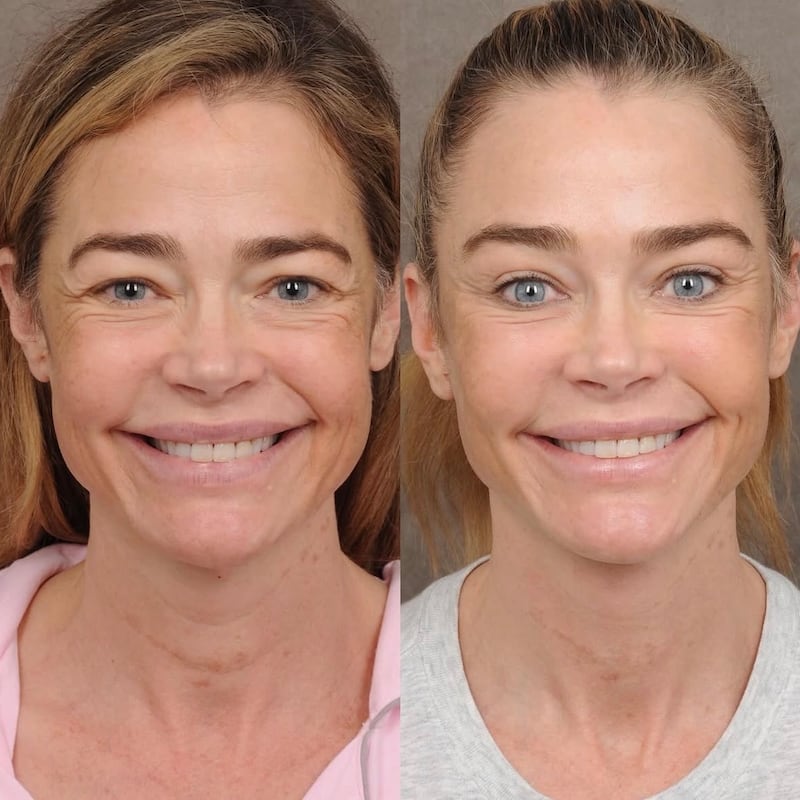 Denise Richards facelift