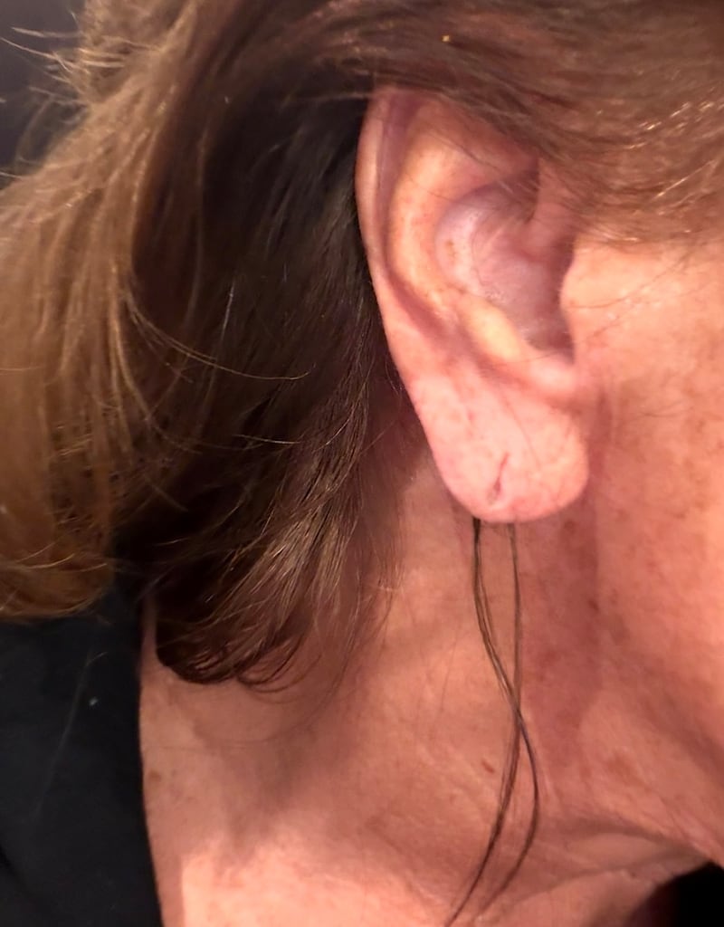Abby Lee Miller said she noticed an instant change after receiving hyaluronic acid filler injections into her earlobes.