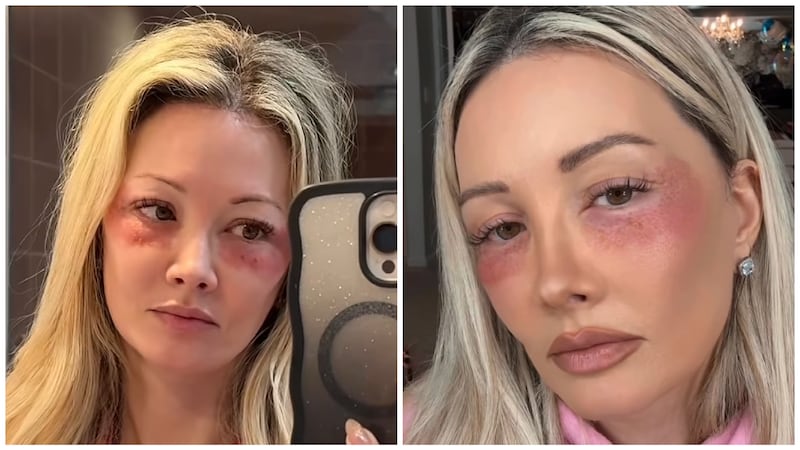 Holly Madison said her appearance was "scary" in the days following the operation.
