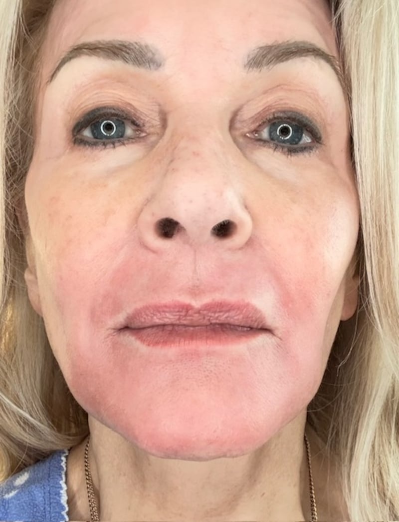 Already 17 days after the procedure, with her skin still pink, Pamela Allyn noticed that the lines around her mouth had diminished.