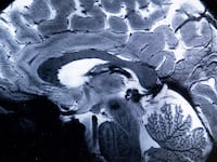 An MRI done in 2024 shows a brain during a magnetic resonance imaging (MRI) exam simulation at the Neurospin facilities in the Paris-Saclay Alternative Energies and Atomic Energy Commission.